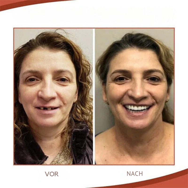 Miroken | Biocompatible  Prosthesis Set for Pain-Free Fit and Natural Smile