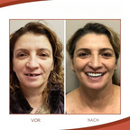 Miroken | Biocompatible  Prosthesis Set for Pain-Free Fit and Natural Smile